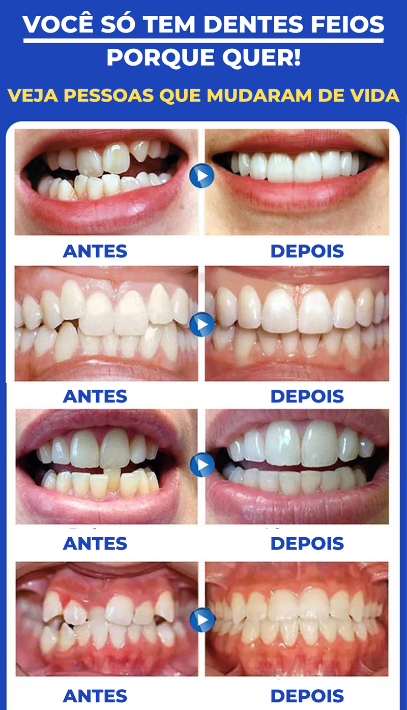 DreamSmile™ - Aparelho ortodôntico
